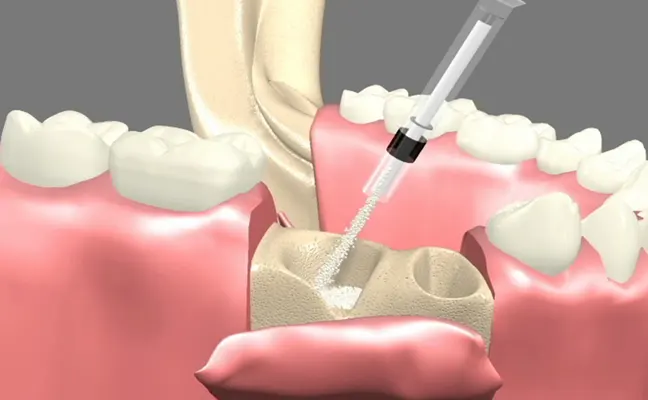 Bone Grafting